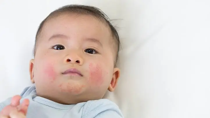 Baby Hives: 8 Common Causes & How to Soothe Them Safely