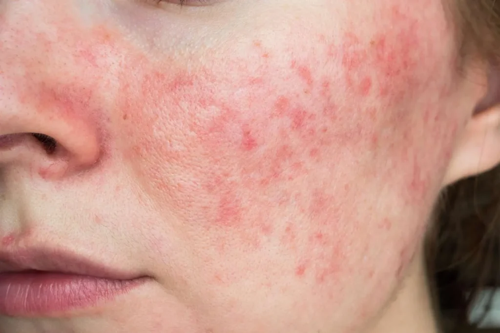 hives on face
