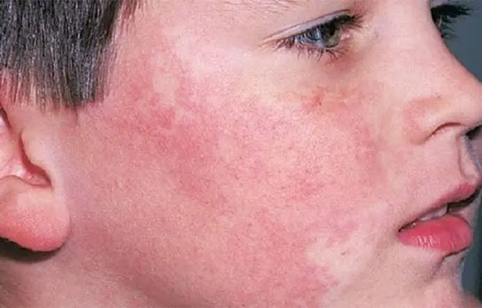 hives on face