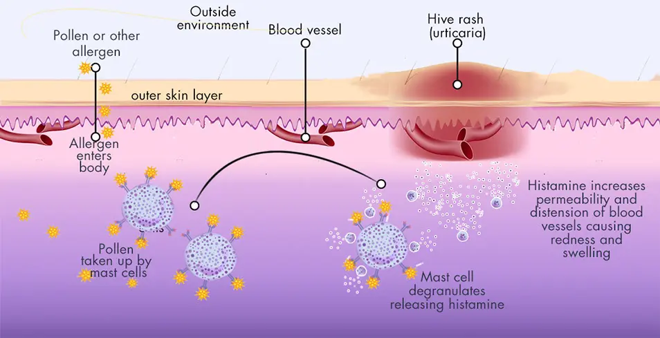 what causes hives